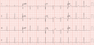 P wave morphology of a Sinus ECG - Cardiac Physiology in Practice