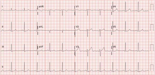 P wave morphology of a Sinus ECG - Cardiac Physiology in Practice
