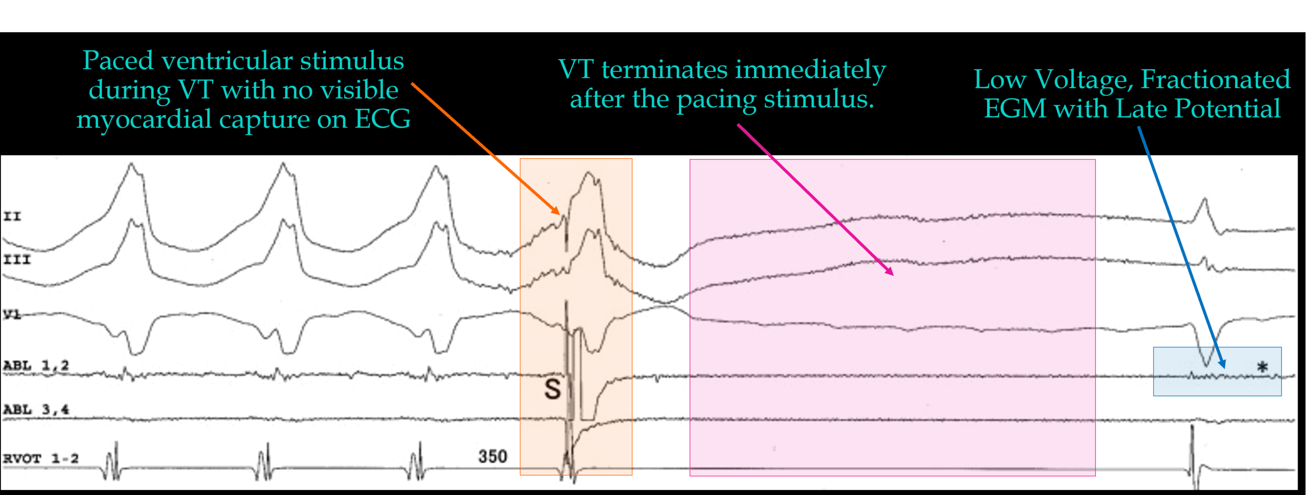 Vt1 Example Re-entry VT: Termination without Global Capture - Cardiac Physiology in ...
