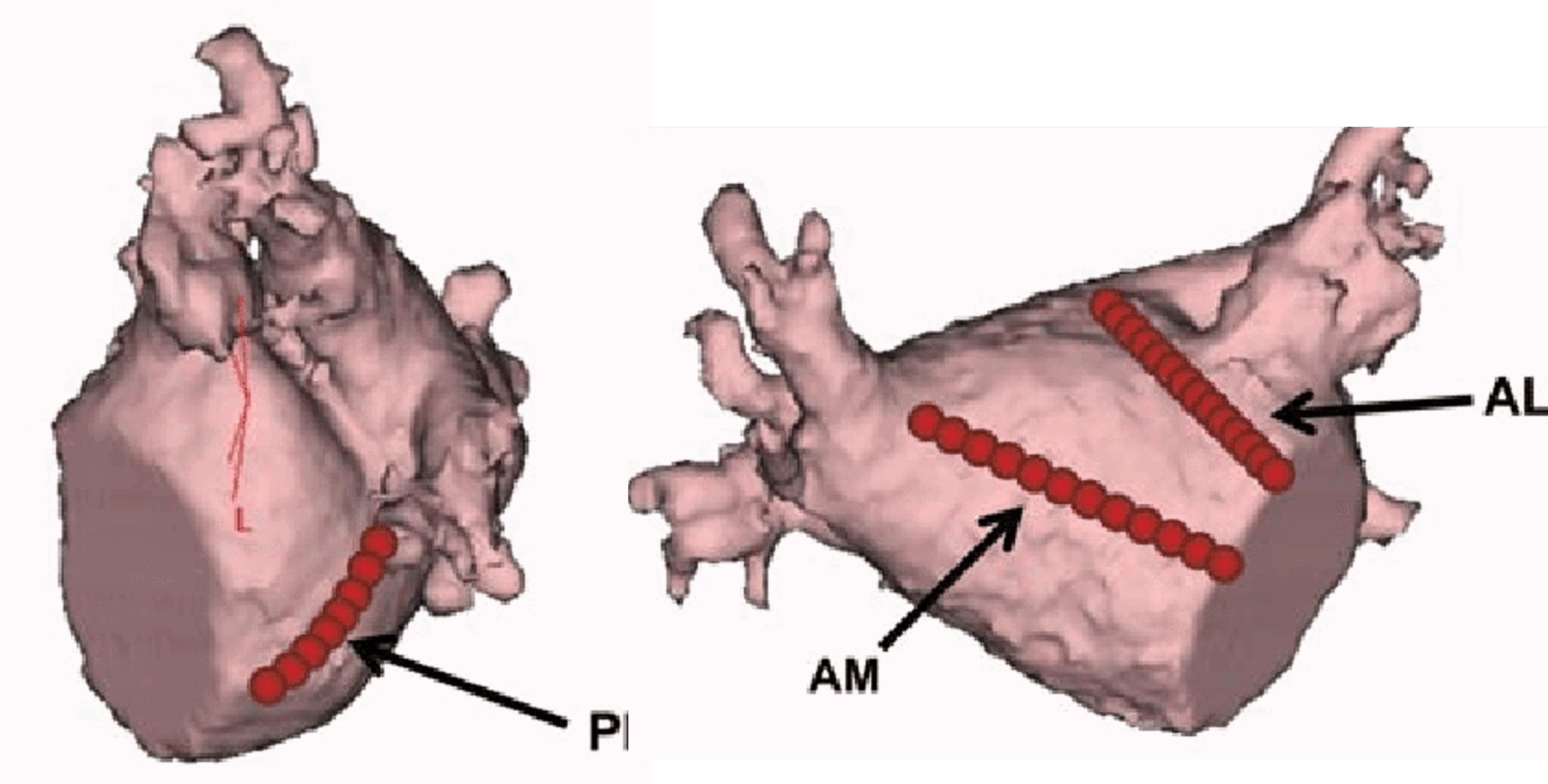 Blocking Posterolateral Mitral Lines - Cardiac Physiology in Practice