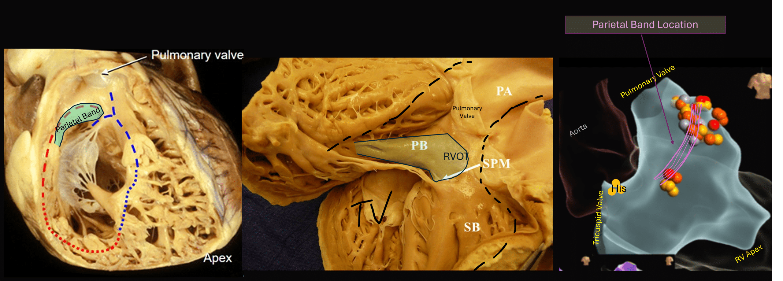 Collapsible Rvot Anatomy Spotlight - Parietal Band during RVOT Ablation - Cardiac ...